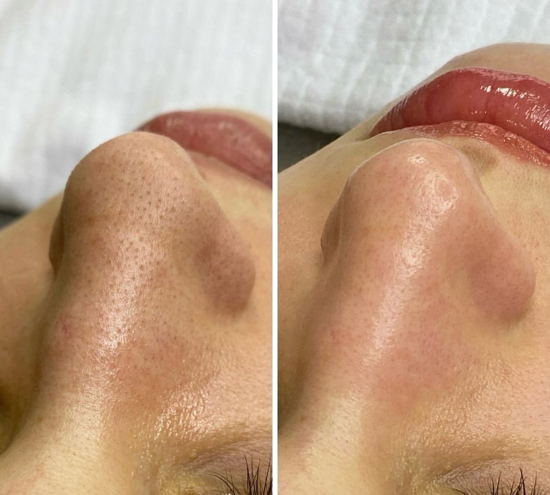 Resultado limpeza de pele 2